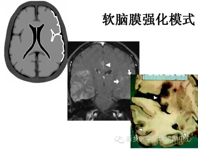 【PPT】可以引起脑膜强化的病例赏析