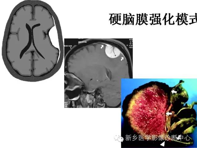 【PPT】可以引起脑膜强化的病例赏析