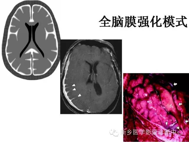【PPT】可以引起脑膜强化的病例赏析