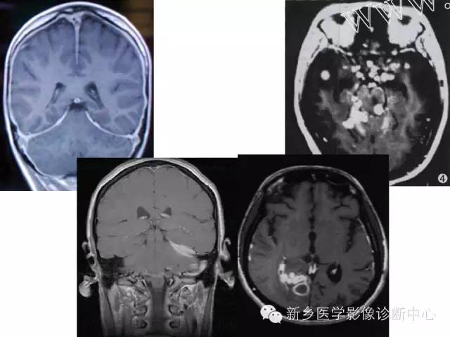 【PPT】可以引起脑膜强化的病例赏析
