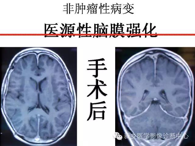【PPT】可以引起脑膜强化的病例赏析