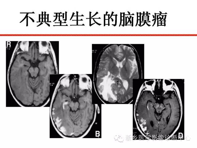 【PPT】可以引起脑膜强化的病例赏析