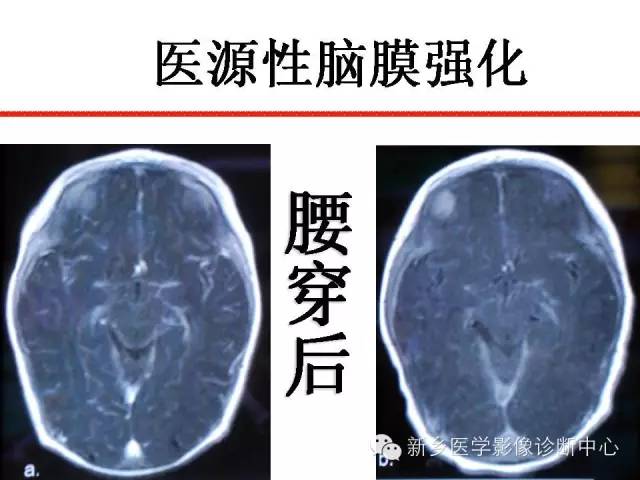 【PPT】可以引起脑膜强化的病例赏析