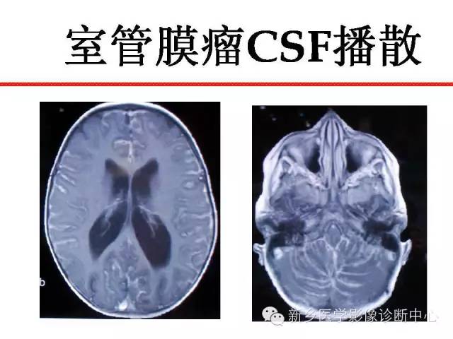 【PPT】可以引起脑膜强化的病例赏析