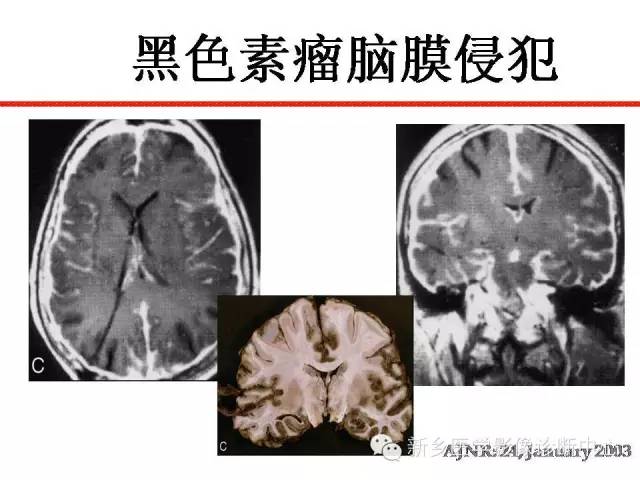 【PPT】可以引起脑膜强化的病例赏析