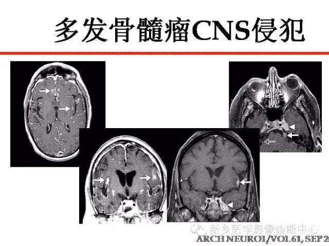 【PPT】可以引起脑膜强化的病例赏析
