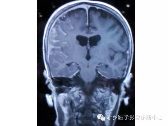 【PPT】可以引起脑膜强化的病例赏析