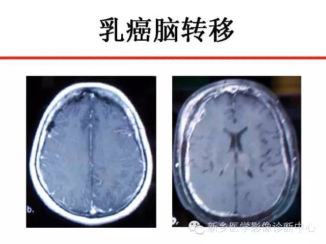 【PPT】可以引起脑膜强化的病例赏析