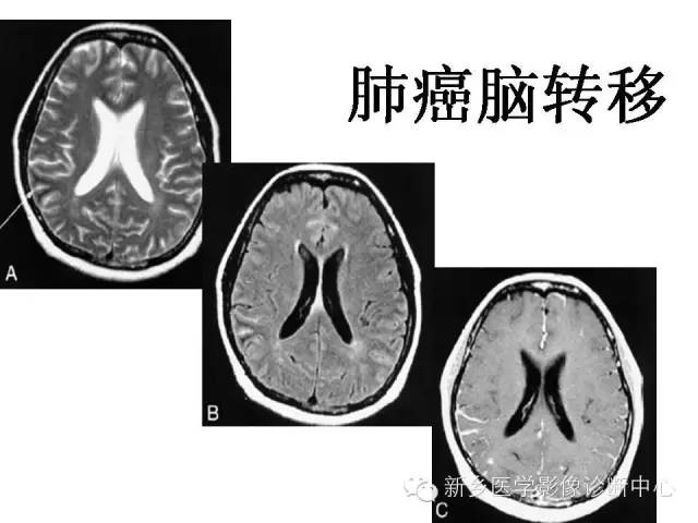 【PPT】可以引起脑膜强化的病例赏析