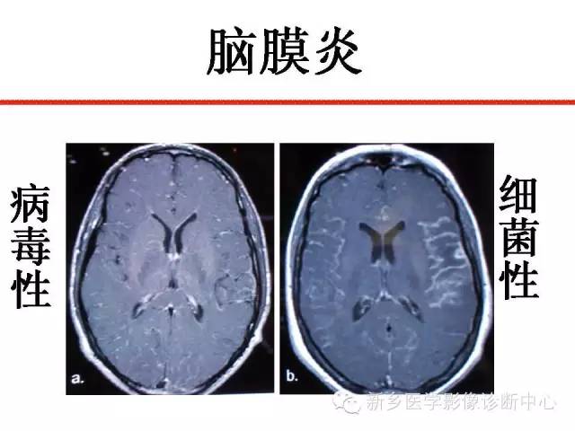 【PPT】可以引起脑膜强化的病例赏析