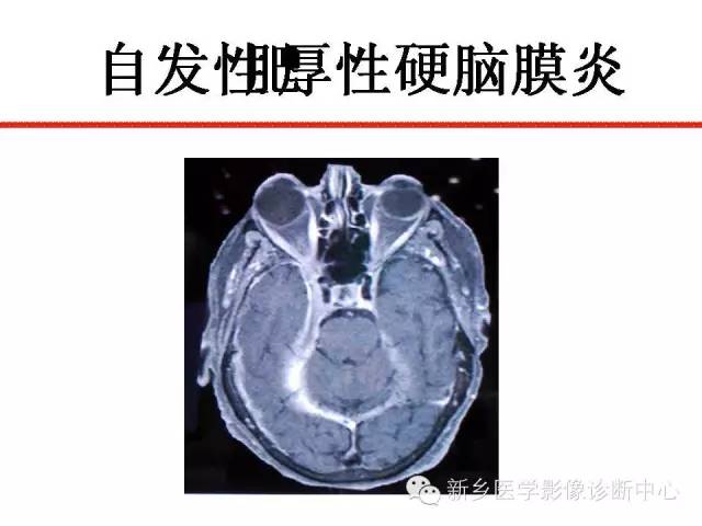 【PPT】可以引起脑膜强化的病例赏析