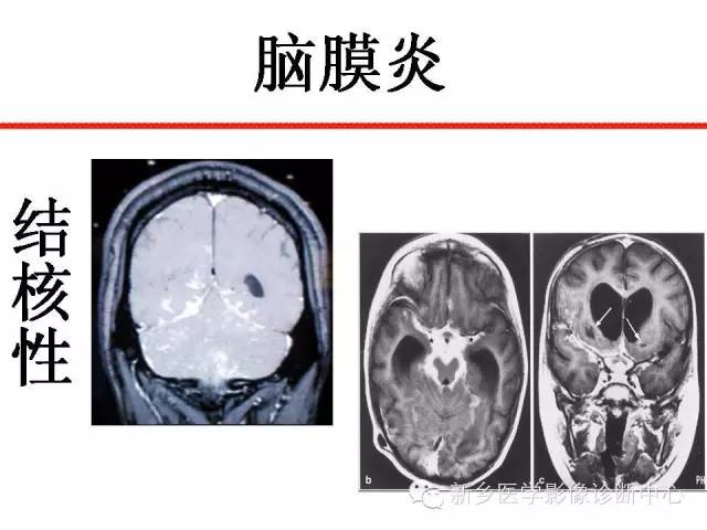 【PPT】可以引起脑膜强化的病例赏析