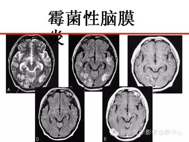 【PPT】可以引起脑膜强化的病例赏析