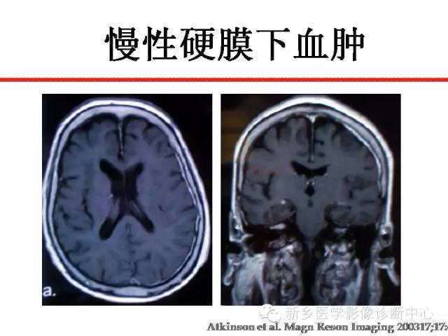 【PPT】可以引起脑膜强化的病例赏析