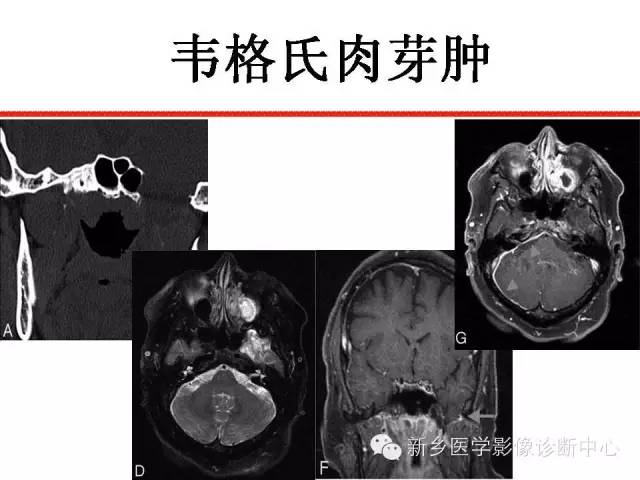 【PPT】可以引起脑膜强化的病例赏析