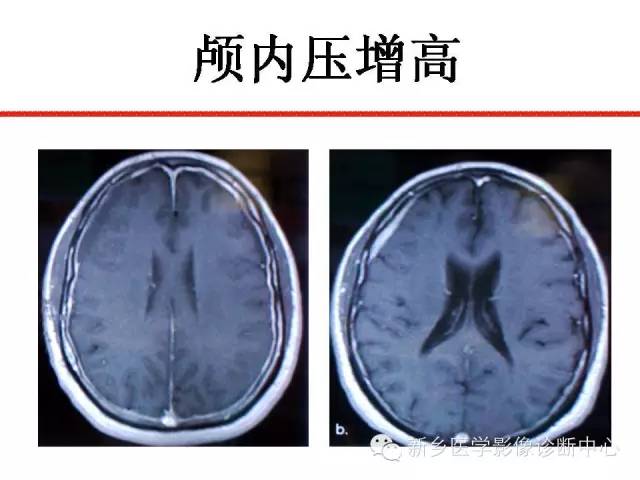 【PPT】可以引起脑膜强化的病例赏析