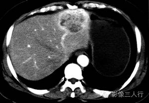 【病例】间质瘤肝转移1例CT影像表现 【病例】间质瘤肝转移1例CT影像表现