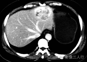 【病例】间质瘤肝转移1例CT影像表现 【病例】间质瘤肝转移1例CT影像表现