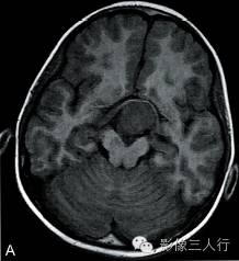 【病例】垂体胚胎癌1例MR影像表现分析 【病例】垂体胚胎癌1例MR影像表现分析