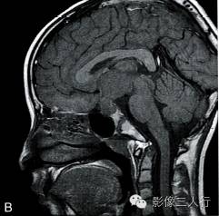 【病例】垂体胚胎癌1例MR影像表现分析
