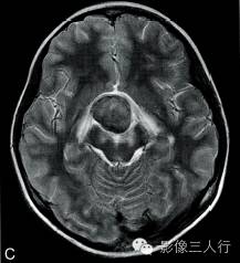 【病例】垂体胚胎癌1例MR影像表现分析 【病例】垂体胚胎癌1例MR影像表现分析