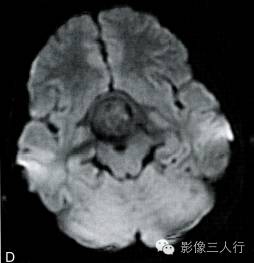 【病例】垂体胚胎癌1例MR影像表现分析 【病例】垂体胚胎癌1例MR影像表现分析