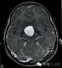 【病例】垂体胚胎癌1例MR影像表现分析 【病例】垂体胚胎癌1例MR影像表现分析
