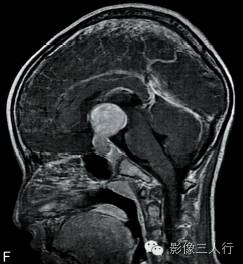 【病例】垂体胚胎癌1例MR影像表现分析 【病例】垂体胚胎癌1例MR影像表现分析