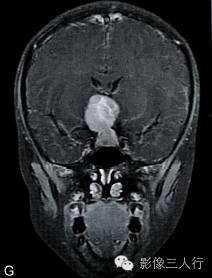 【病例】垂体胚胎癌1例MR影像表现分析 【病例】垂体胚胎癌1例MR影像表现分析