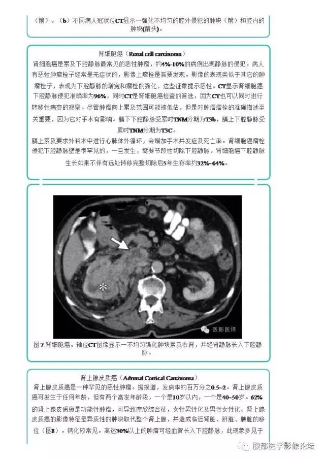 下腔静脉疾病的影像诊断