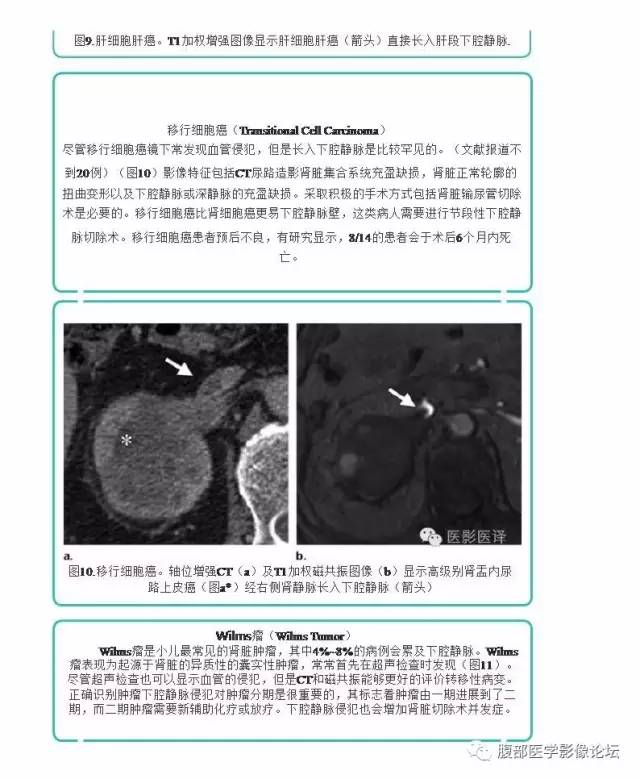 下腔静脉疾病的影像诊断