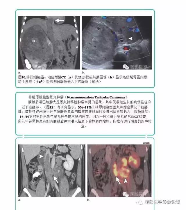 下腔静脉疾病的影像诊断
