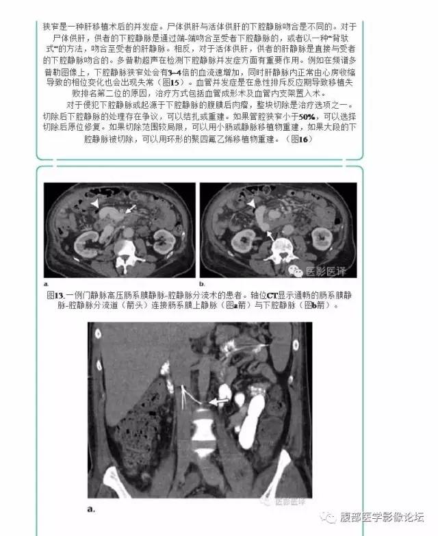 下腔静脉疾病的影像诊断