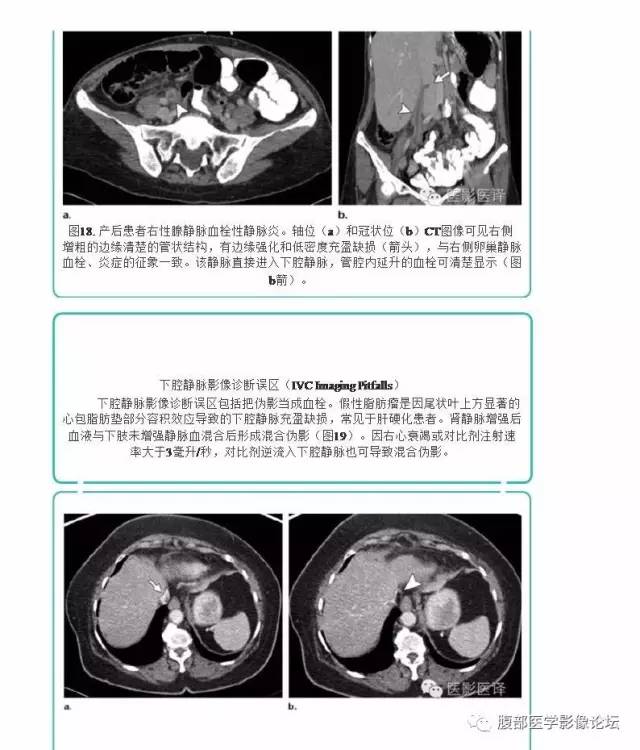 下腔静脉疾病的影像诊断