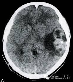 【病例】左侧颞叶室管膜母细胞瘤1例MR影像表现分析