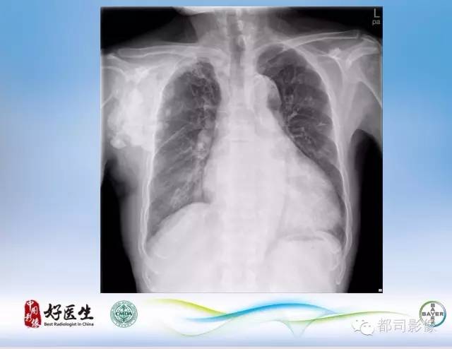 【PPT】骨关节影像病例分析