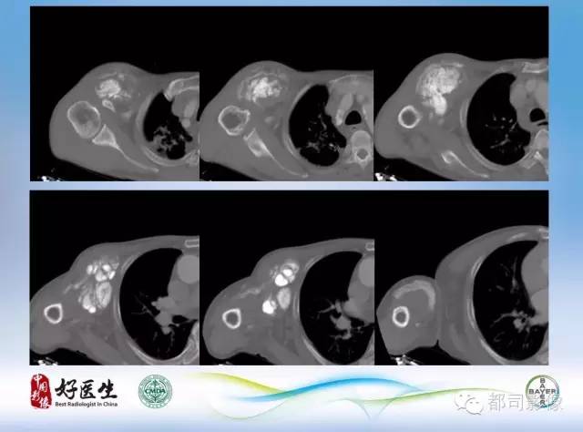 【PPT】骨关节影像病例分析