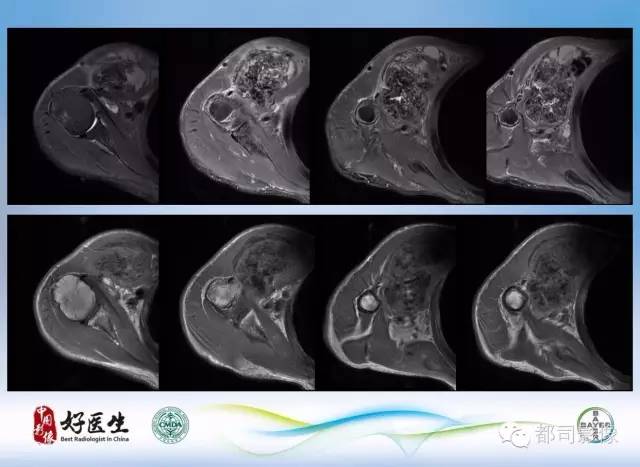 【PPT】骨关节影像病例分析