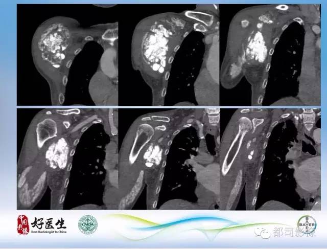 【PPT】骨关节影像病例分析