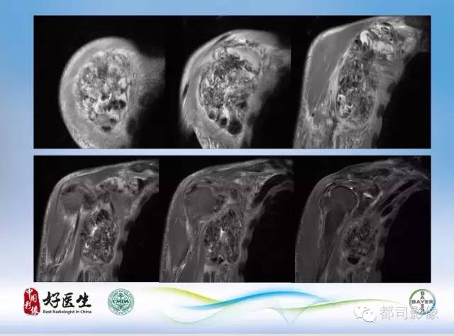 【PPT】骨关节影像病例分析
