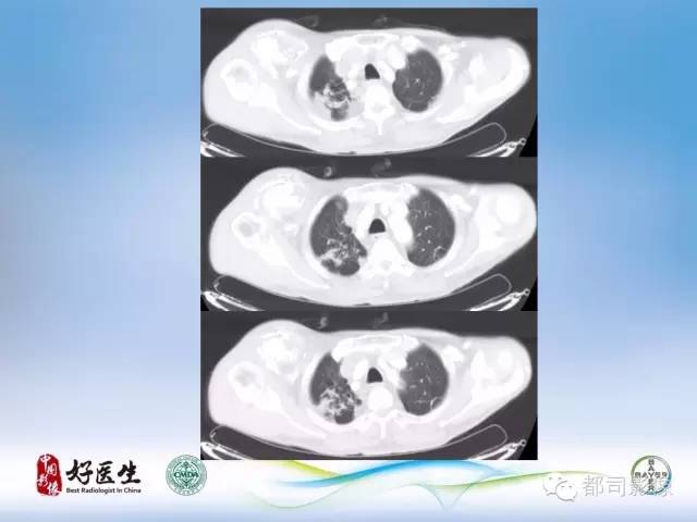 【PPT】骨关节影像病例分析
