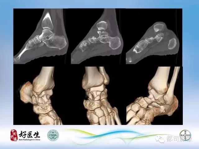 【PPT】骨关节影像病例分析