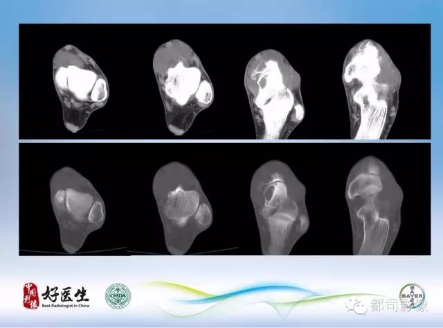 【PPT】骨关节影像病例分析