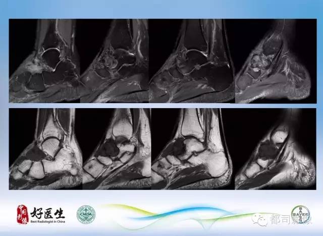 【PPT】骨关节影像病例分析
