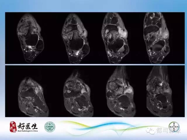 【PPT】骨关节影像病例分析
