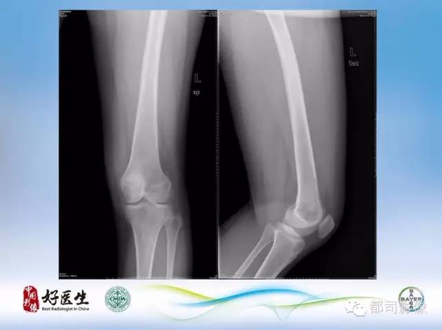 【PPT】骨关节影像病例分析