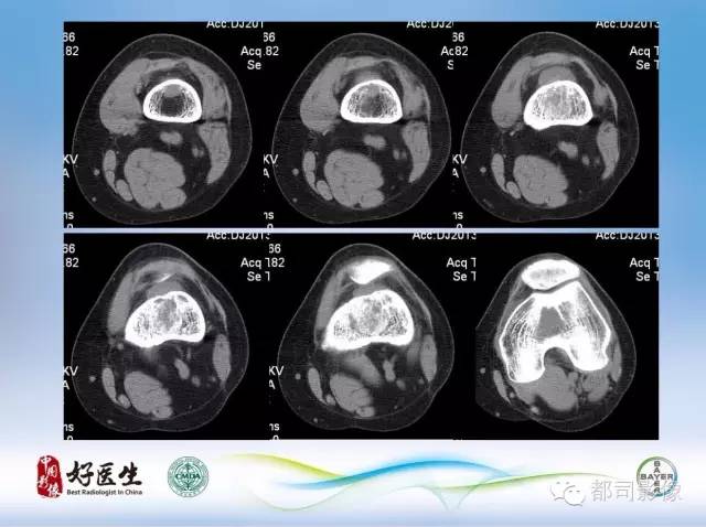 【PPT】骨关节影像病例分析