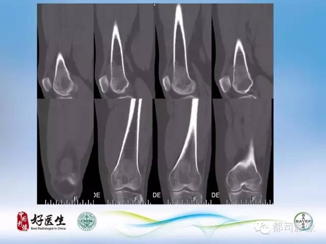 【PPT】骨关节影像病例分析