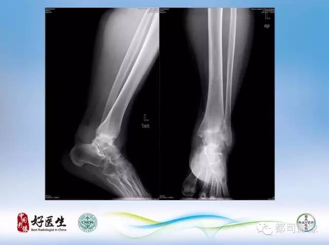 【PPT】骨关节影像病例分析