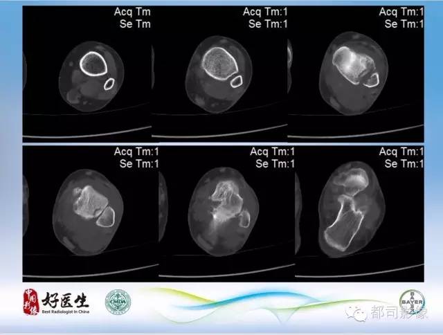 【PPT】骨关节影像病例分析